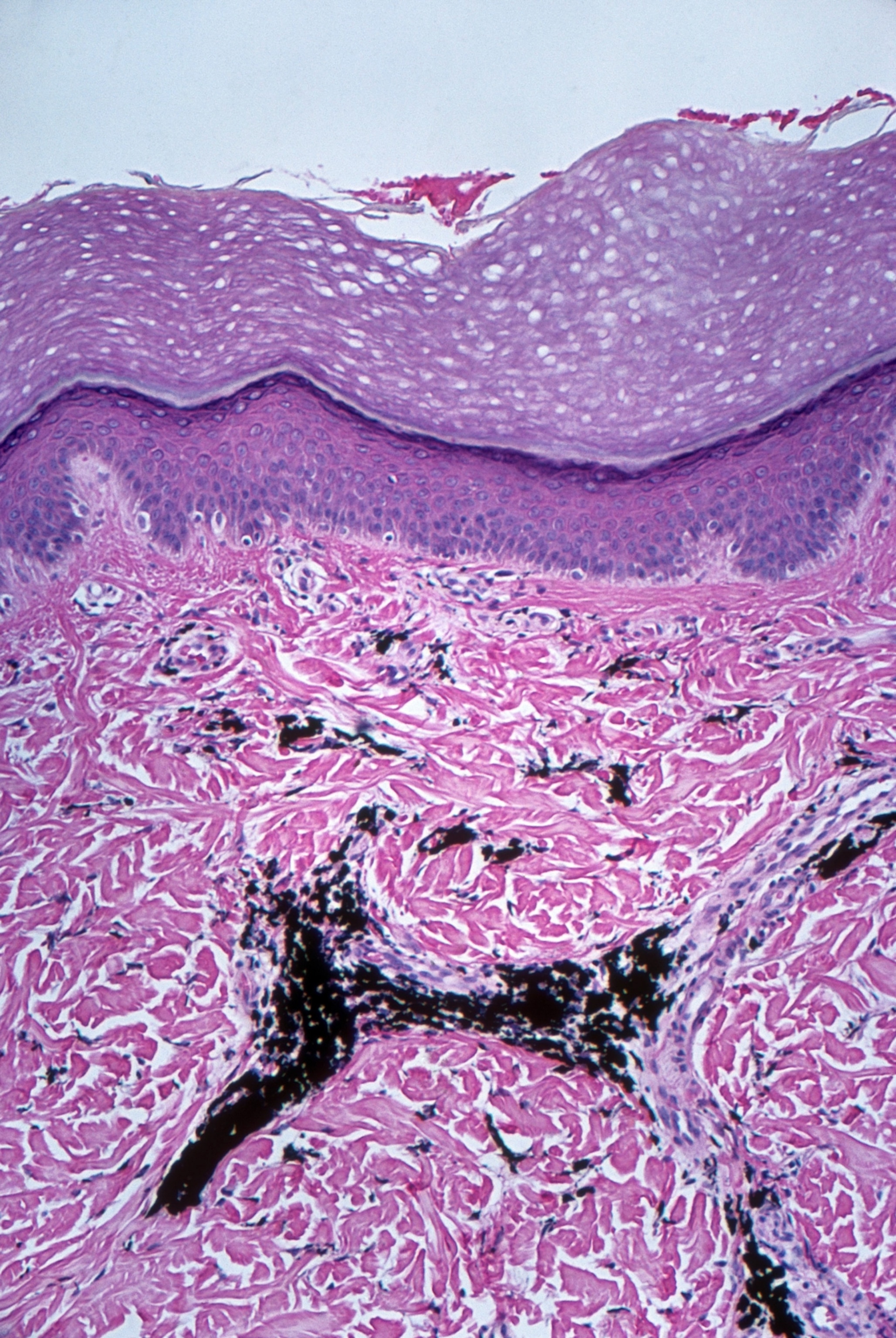 A microscopic cross section of skin, with a visible deposit of black ink beneath the outer layers of skin