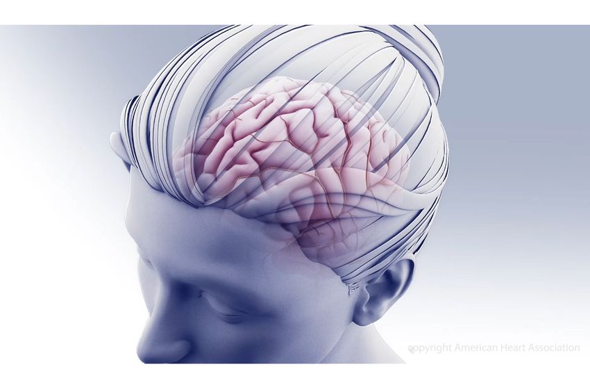 Started within 48 hours of stroke, neuroprotective medication helped brain cells, recovery