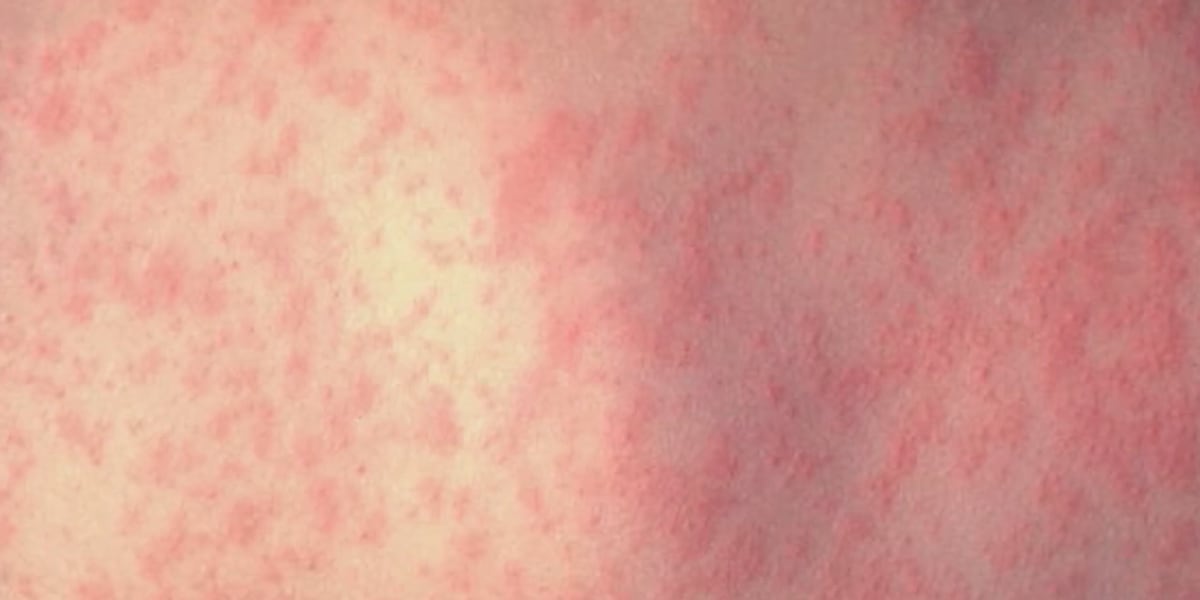 Mo. & Ill. health officials warn of possible measles exposures in St. Louis area