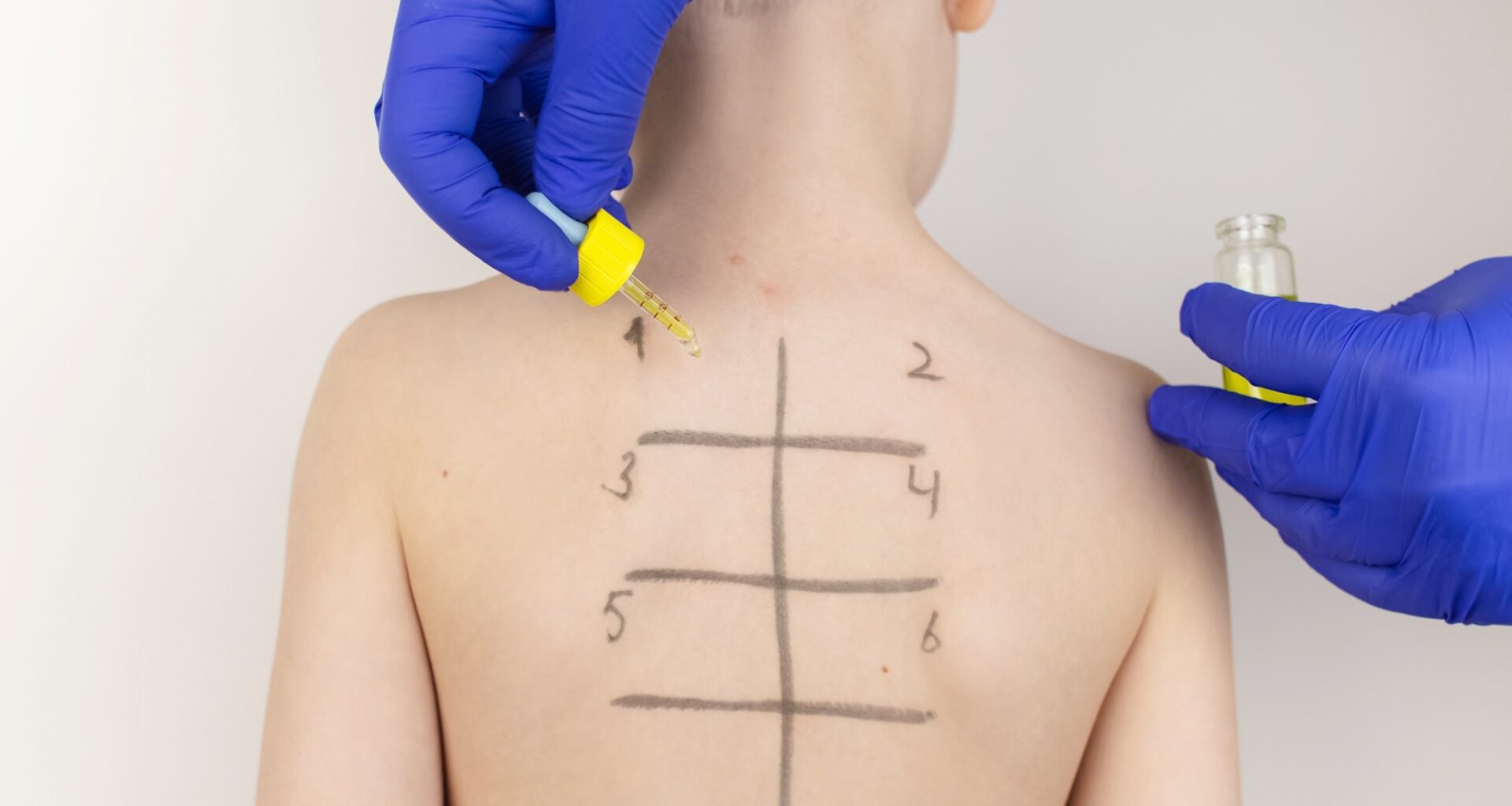 An allergist in the laboratory conducts an allergy prick-test. Child patient back with square grid drawn on back