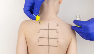 An allergist in the laboratory conducts an allergy prick-test. Child patient back with square grid drawn on back