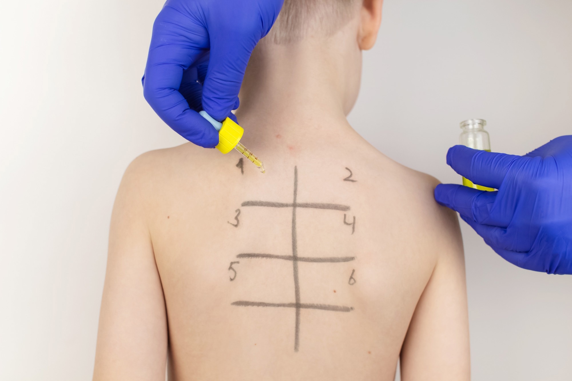 An allergist in the laboratory conducts an allergy prick-test. Child patient back with square grid drawn on back