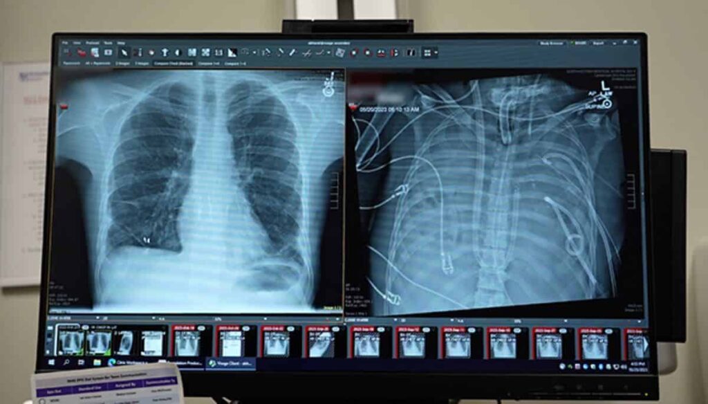 Ray showing lungs and ribcage with medical imaging analysis on a computer screen.