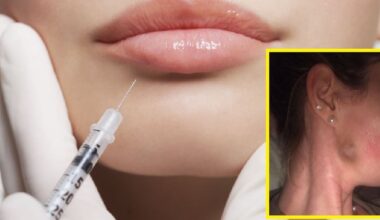 Unregulated dermal filler procedures pose serious threat to health, says medical group – The Irish Times