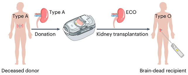 Kidney transplant illustration