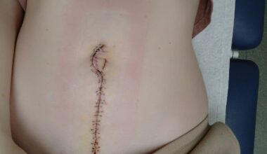 Woman claims infertility ignored by doctors, tumours found on ovaries and bowels