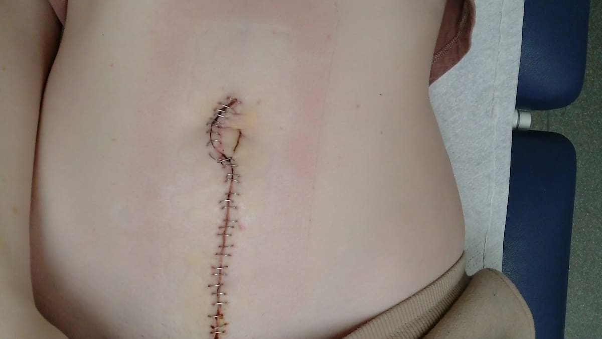 Woman claims infertility ignored by doctors, tumours found on ovaries and bowels