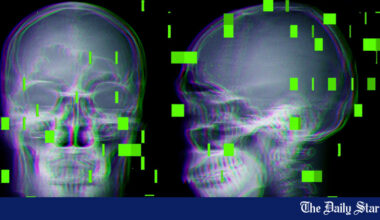 As AI enters the operating room, reports arise of botched surgeries and misidentified body parts