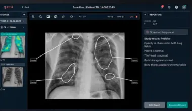 NHS launches AI and robot pilot to spot lung cancer