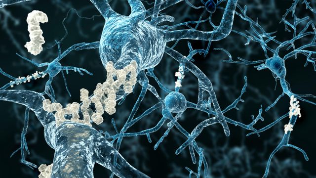 CAR T Therapy Shows Promise for Alzheimer’s Treatment