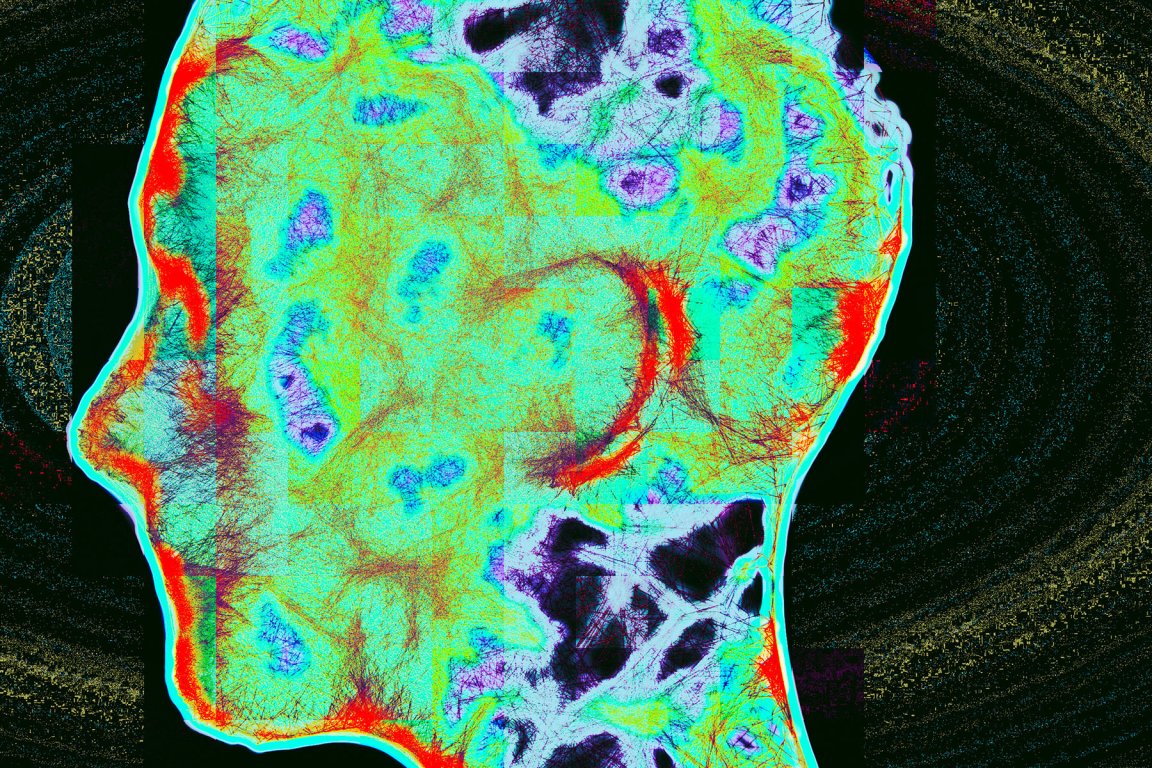 Color-enhanced brain scan showing a side profile of a human head. The image uses bright colors including cyan, red, purple, and black to highlight different areas and textures.