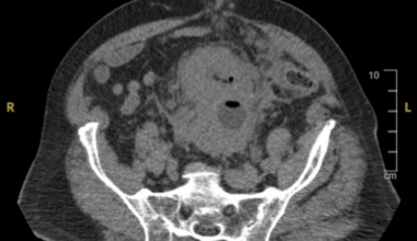 Urothelial Bladder Cancer With Cardiac Metastasis: A Case Report