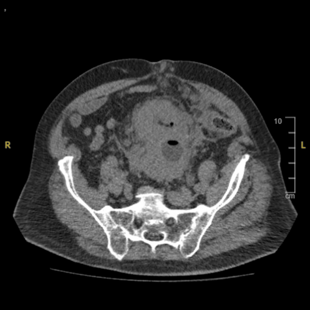 Urothelial Bladder Cancer With Cardiac Metastasis: A Case Report