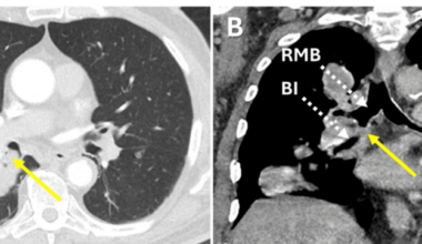 Endoscopic Debulking in the Management of Osteosarcoma With a Rare Endobronchial Metastasis