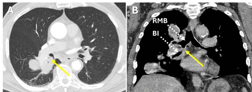 Endoscopic Debulking in the Management of Osteosarcoma With a Rare Endobronchial Metastasis