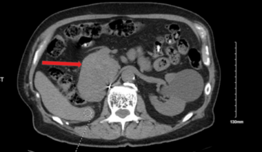 Clear Cell Renal Cell Carcinoma Recurrence Three Decades After Nephrectomy Presenting With New-Onset Diabetes