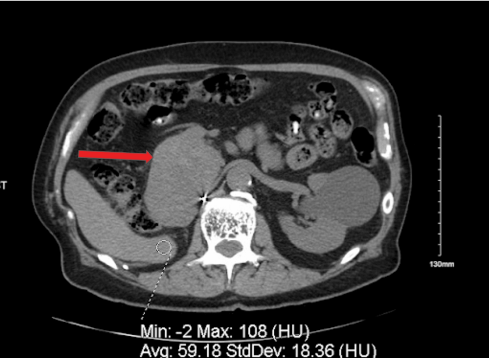 Clear Cell Renal Cell Carcinoma Recurrence Three Decades After Nephrectomy Presenting With New-Onset Diabetes