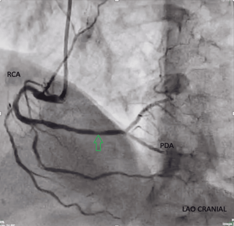 Strategizing the Treatment Plan for Managing Comorbid Cervical Carcinoma With Coronary Artery Disease Using Coronary Artery Bypass Grafting and Definitive Oncotherapy