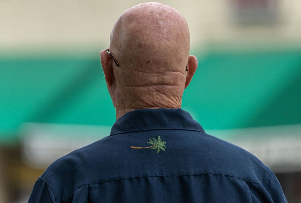 Baldness breakthrough or media hype?