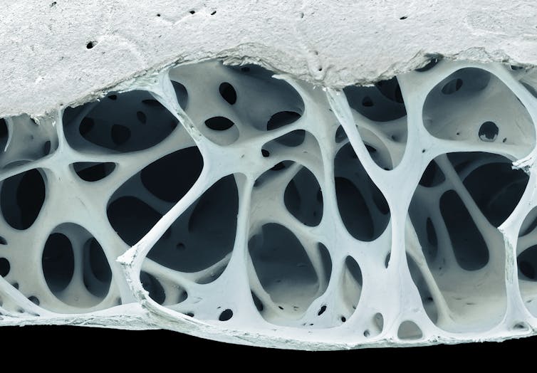 A cross-section view of bone, showing large, roughly circular holes in a white material.