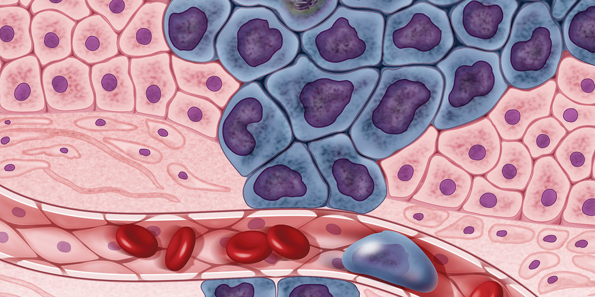 Revealing the glycoproteome of a cancer subtype