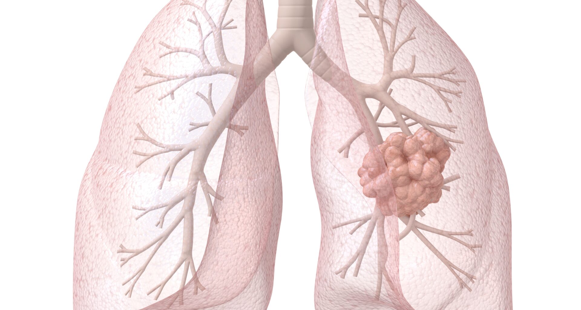 Community Oncology Connections™: Beyond Primary End Points – Digging Into Randomized and Real-World Data to Guide Challenging Treatment Decisions in HR+/HER2− Metastatic Breast Cancer