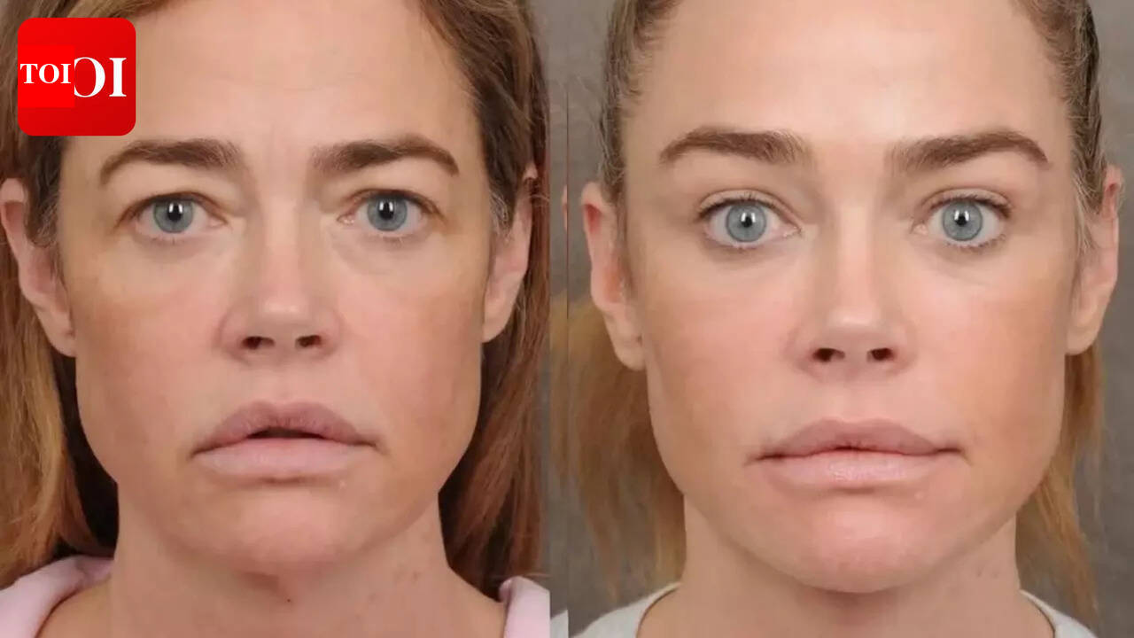Denise Richards opens up about facelift; surgeon hails actress for bravely sharing 'before and after' pics of work done on forehead, eyes, mouth, neck |