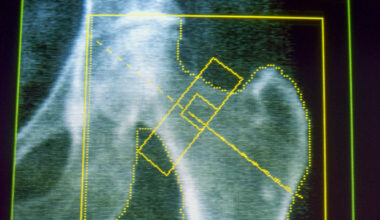 GLP-1s may increase risk of osteoporosis and gout, new research finds