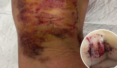 SunLive - Mount woman left traumatised after dog mauling