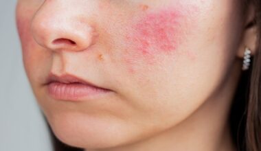 Rosacea and Depression Risk: New Cohort Evidence - EMJ