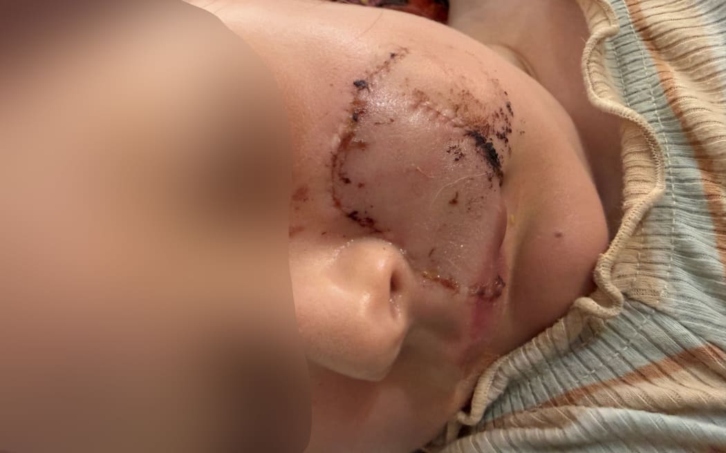 Dog attack - child victim blurred - 3 March 2026