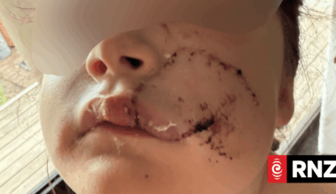 Dog not euthanised after biting off part of young girl's face