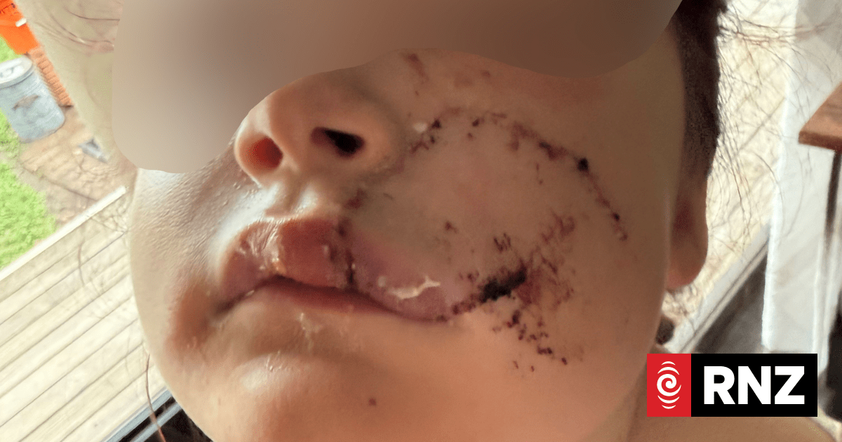 Dog not euthanised after biting off part of young girl's face