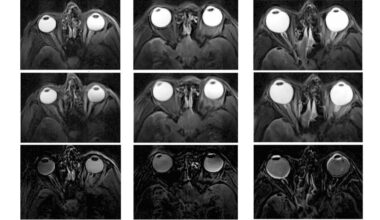 Metamaterial antennas enhance MR images of the eye and brain – Physics World