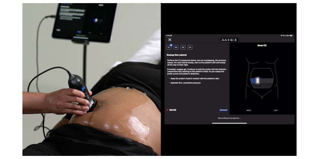 Butterfly Network Secures First FDA Clearance for Blind Sweep Ultrasound AI Tool, Marking a Major Stride for Women’s Health