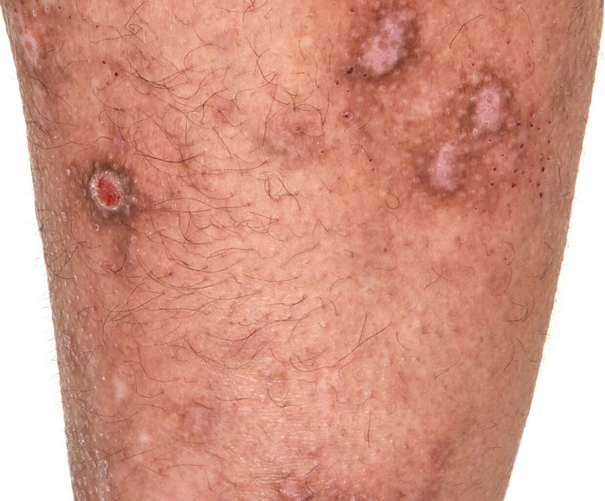 Managing severe atopic dermatitis with culturally informed approach