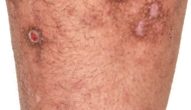 Managing severe atopic dermatitis with culturally informed approach