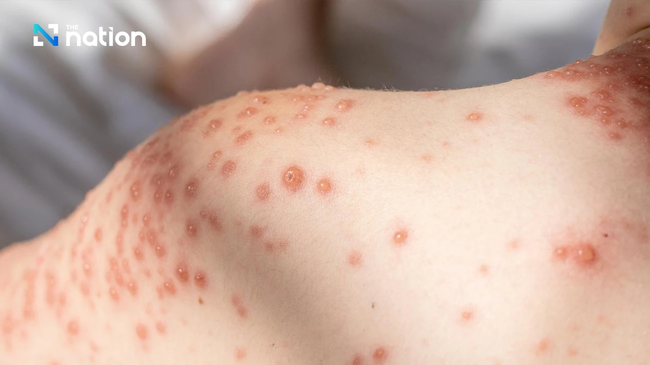 Probe conducted on chickenpox outbreak at Thai university