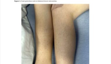 Scurvy diagnosis: Autistic boy, aged 5, lived on diet of chicken and biscuits