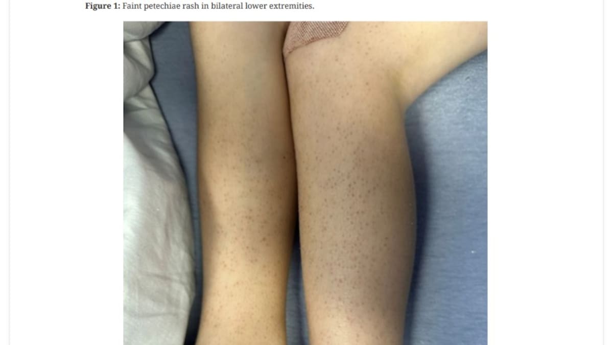 Scurvy diagnosis: Autistic boy, aged 5, lived on diet of chicken and biscuits