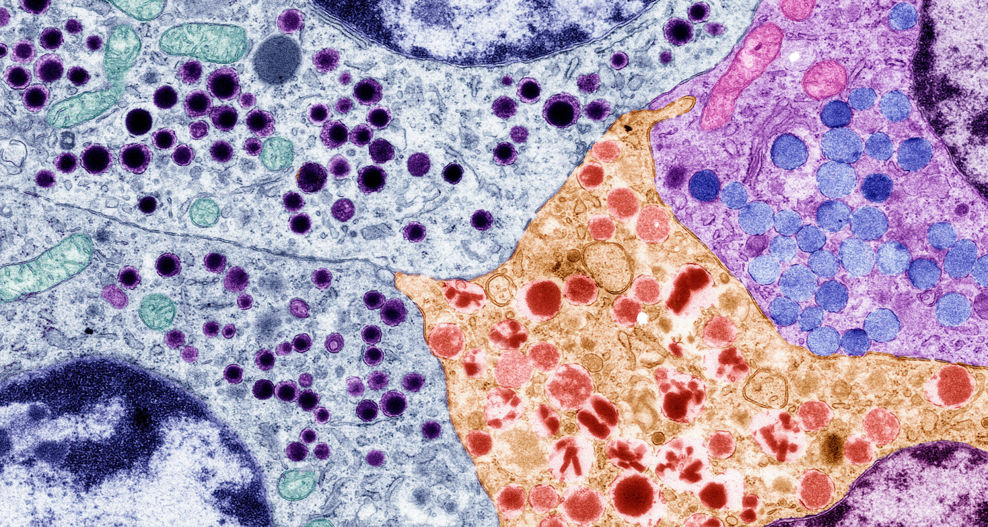 Gene-modified pancreas cells offer hope for people with type 1 diabetes