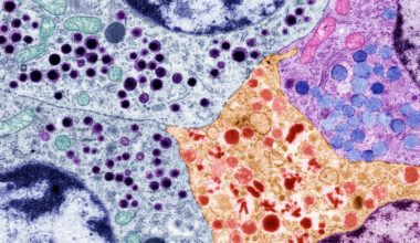 Gene-modified pancreas cells offer hope for people with type 1 diabetes