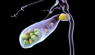 Study: Association between total dietary sugar intake and gallstones in Americans. Image Credit: Kateryna Kon / Shutterstock