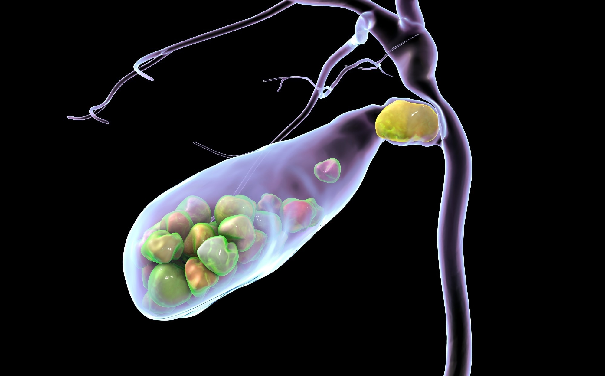 Study: Association between total dietary sugar intake and gallstones in Americans. Image Credit: Kateryna Kon / Shutterstock