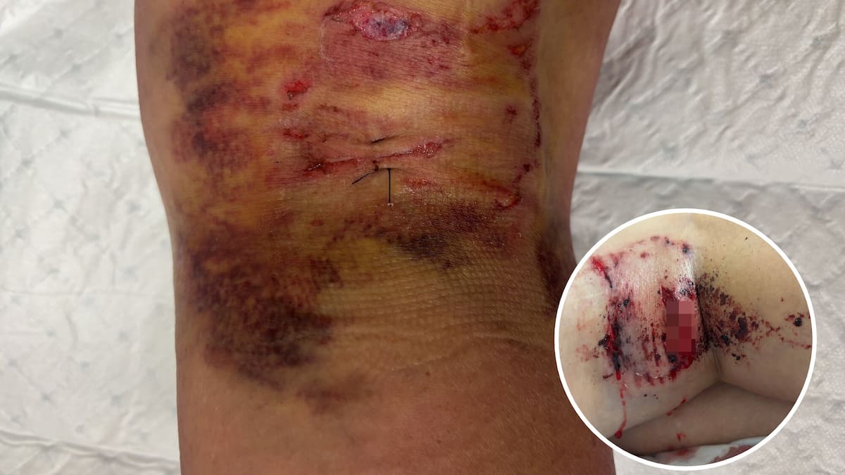 Tauranga dog attack survivor ‘disgusted’ council hasn’t prosecuted owner