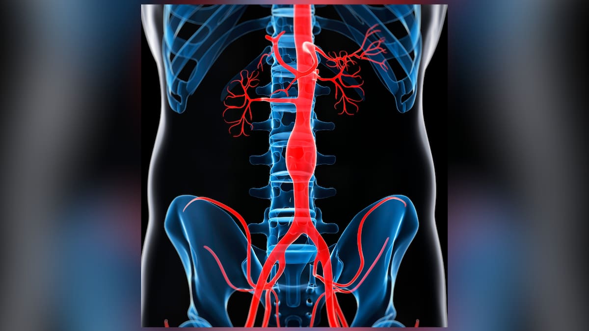 Abdominal aortic aneurysm survivor: ‘Hundreds of NZers deserve the chance at a future that I’ve been given’