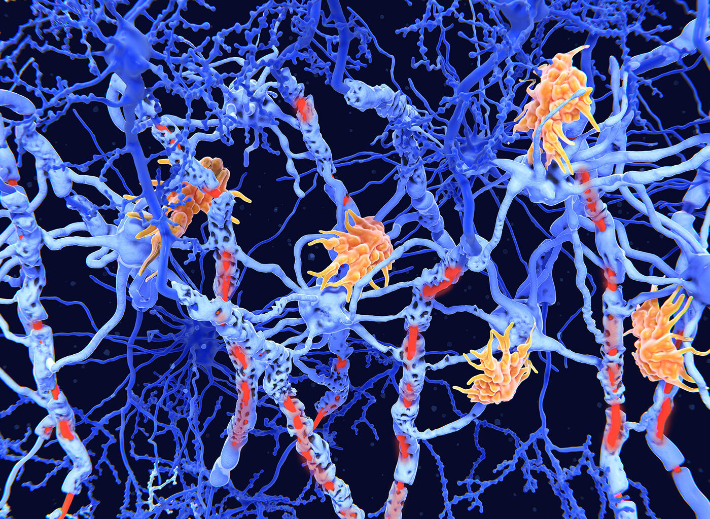 Gut-Immune Link Identified in Multiple Sclerosis-Related Neuroinflammation