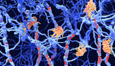Gut-Immune Link Identified in Multiple Sclerosis-Related Neuroinflammation