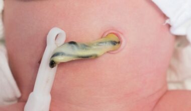 Chlorhexidine reduces umbilical cord infections in newborns