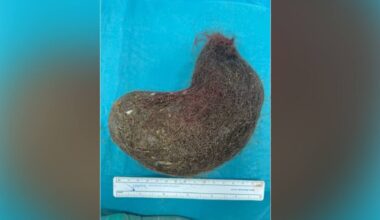 Surgeons remove 30cm-long hairball from stomach of teen with hair-eating disorder